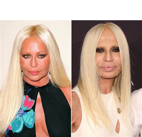 donatella versace plastic surgery 2022